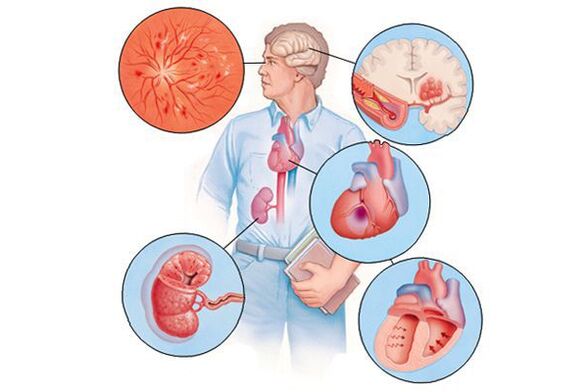 Bojājumi dažādiem orgāniem ar ilgstošu arteriālo hipertensiju